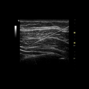 Introduction Training to Scanning Technique and Ultrasound Anatomy of Peripheral Nerve Blocks in Adults